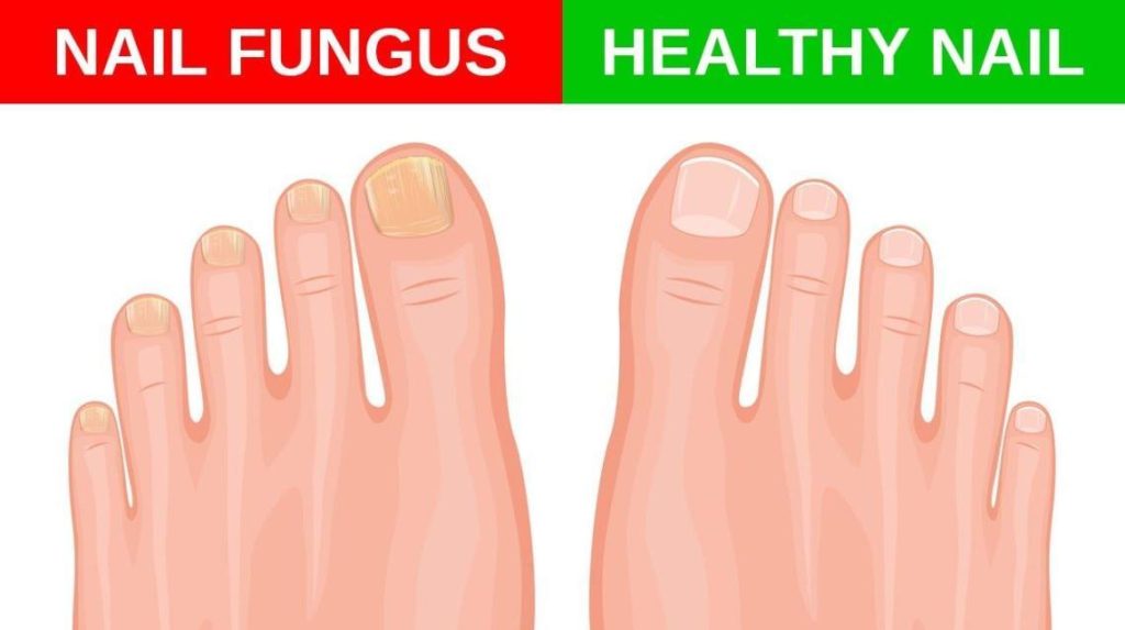 Toenail Fungal Infection and It’s Risk Factors Orthofitmart